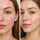 Smart LED Acne Patch – Red & Blue Light Spot Treatment